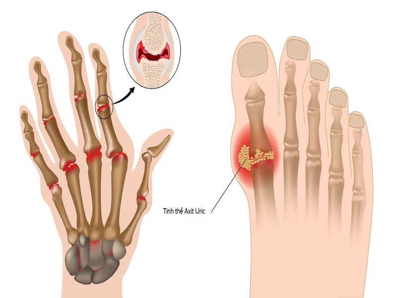 Sơ lược về bệnh gút