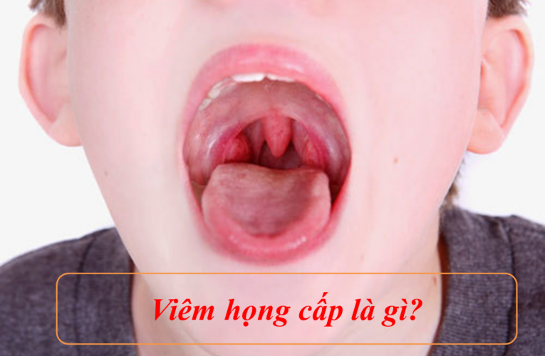 Làm thế nào để phòng ngừa bệnh viêm họng cấp ở trẻ đúng cách?