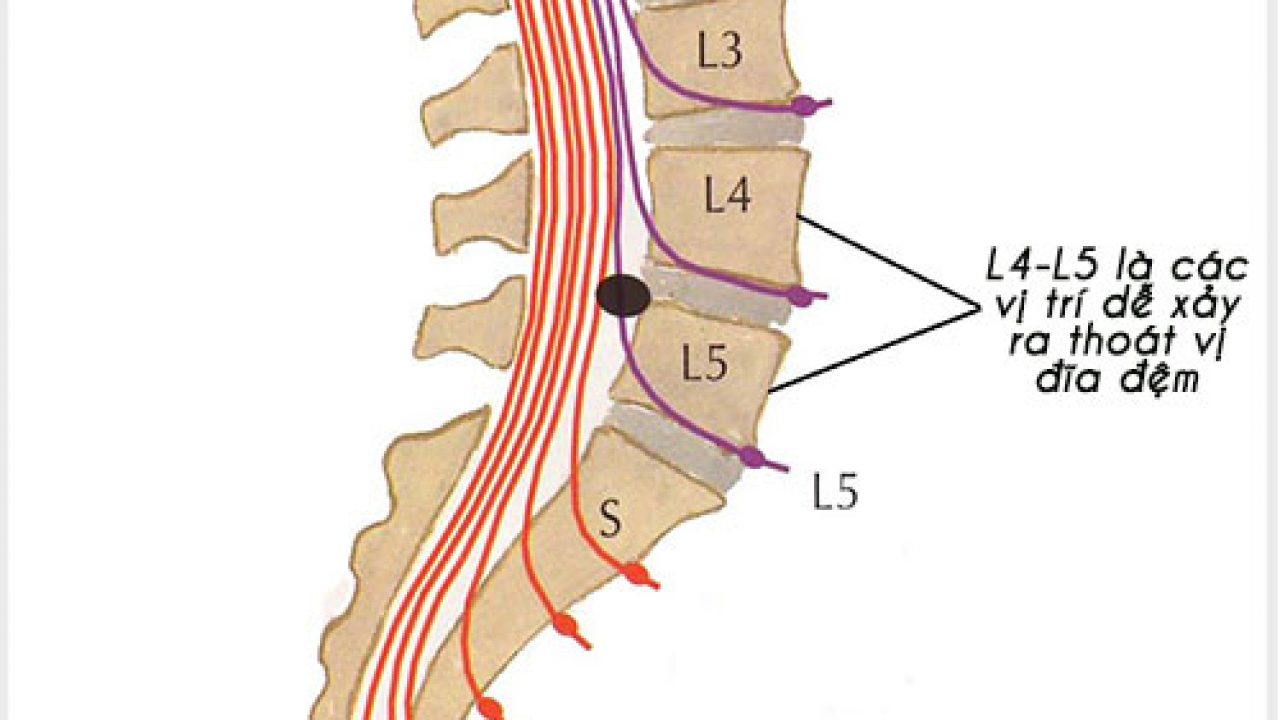 thoát vị đĩa đệm