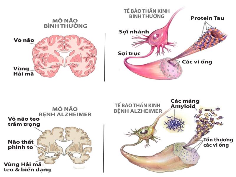 Alzheimer là bệnh gì?