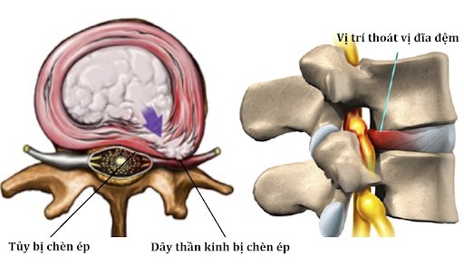 Điều trị thoát vị đĩa đệm